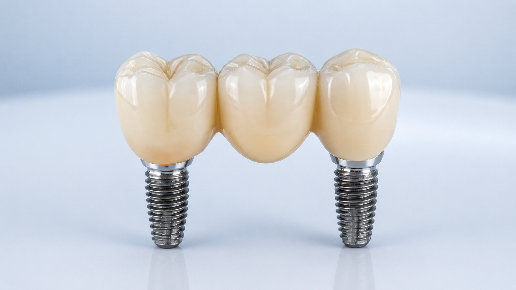 Implant-Supported Bridges